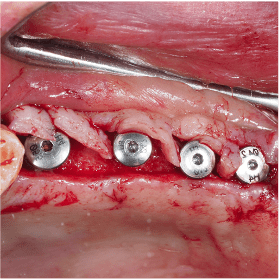 Cycle Initial en Implantologie Chirurgicale et Prothetique (7)